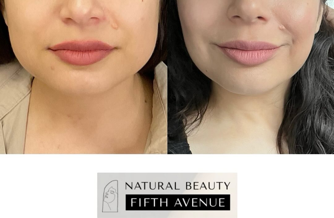 Before and after lip filler results showing fuller, more defined lips at Natural Beauty Fifth Avenue